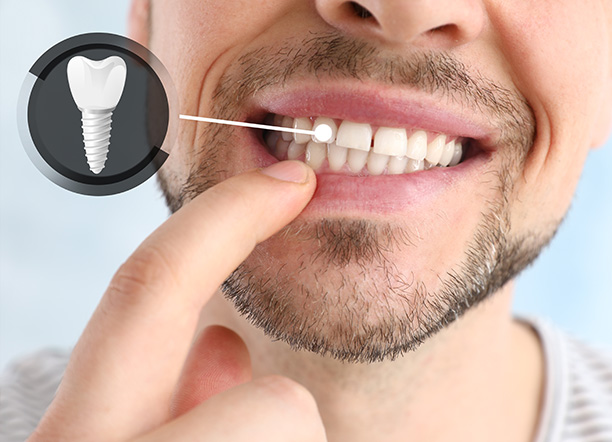 Chadha Co Dental | Preventative Program, Digital Radiography and Fluoride Treatment